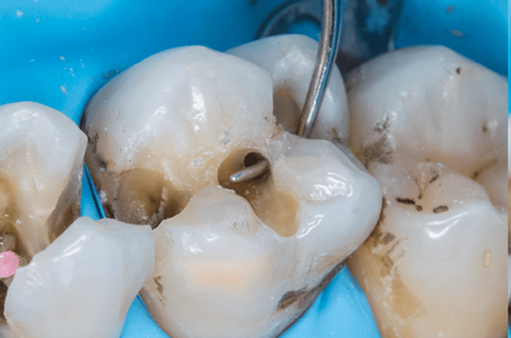 3. Une exérèse carieuse fine est réalisée en prenant soin de préserver le maximum de tissu dentaire.
