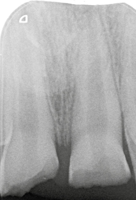 3. Radiographie initiale de 11 et 21 objectivant la fracture corono-radiculaire de 11 et 21.