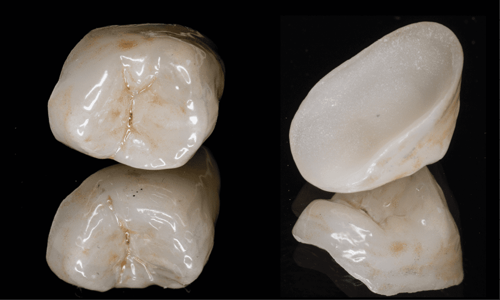 8. La limite périphérique moins cervicale de l’overlay en céramique comparé aux couronnes conventionnelles permet de préserver davantage de tissu dentaire lors de la préparation et de maximiser les valeurs d’adhésion lors du collage.