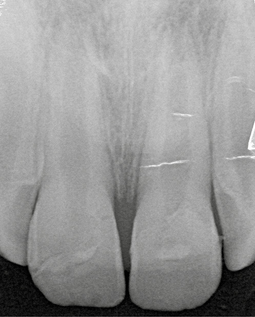 8. Radiographie post-opératoire (à 1 semaine) de 11 et 21 objectivant le positionnement des fragments.