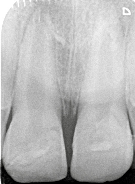 9. Radiographie post-opératoire (à 3 mois) de 11 et 21 permettant de vérifier la poursuite de l’apexogenèse et l’absence d’image radio-claire.