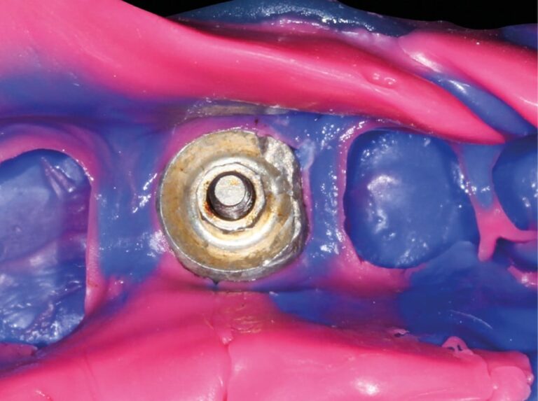 4. Empreinte implantaire inexploitable, réalisée avec un transfert abîmé (Photo : Nicolas Laferté, Laboratoire LDL).
