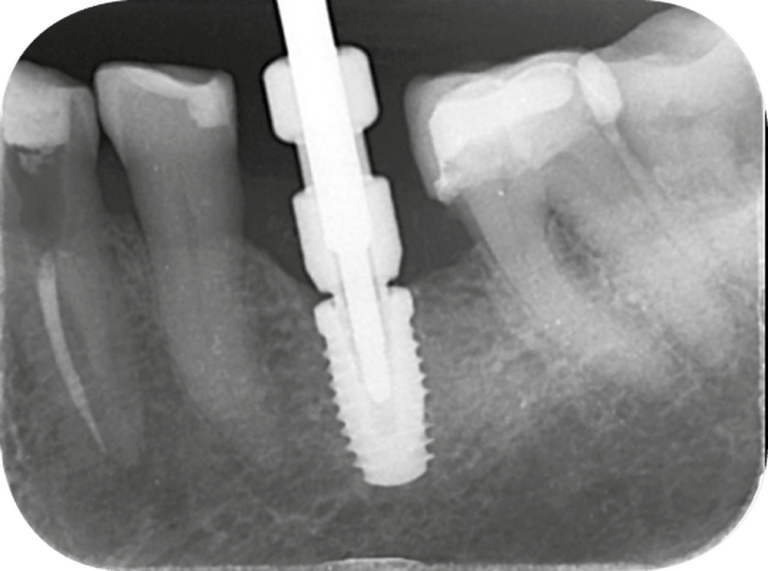 9. Radios extraction des vis de cicatrisation des implants et assemblage des transferts