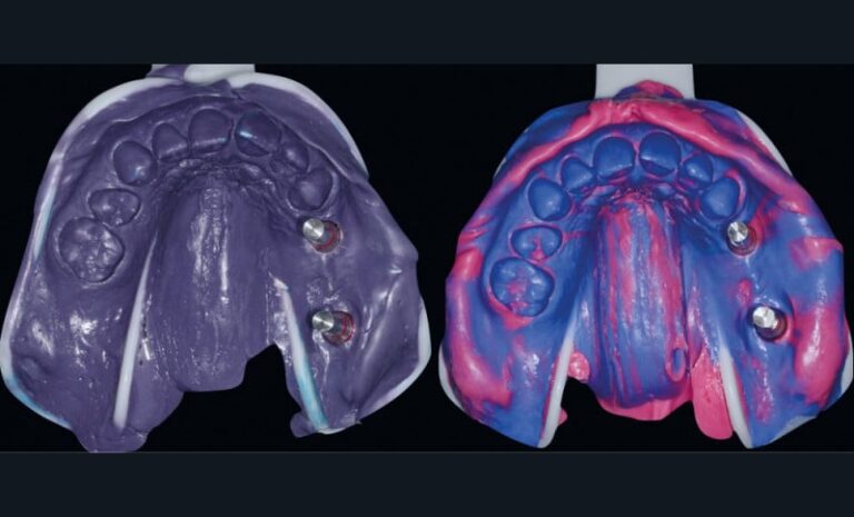 24. Empreintes implantaires. À gauche : polyéther (Impregum, 3M). À droite : silicones (light et putty) en double mélange (Hydrorise, Zhermack).