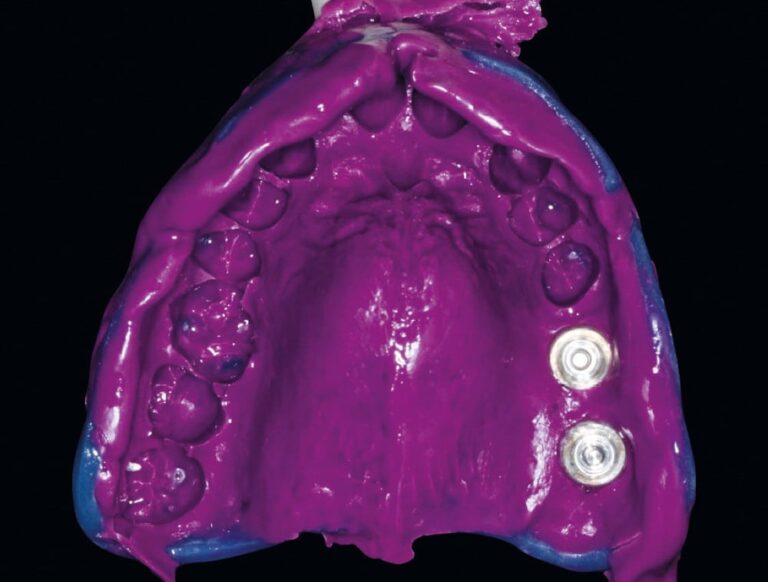 25. Empreinte implantaire silicone en monophase (Hydrorise, Zhermack).