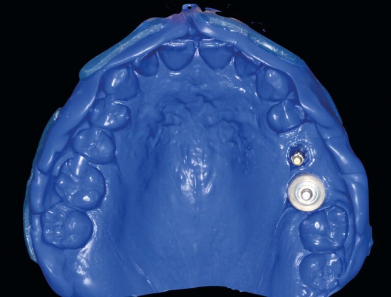 26. Empreinte implantaire silicone en monophase (MaxiHeavy Body, Zhermack).