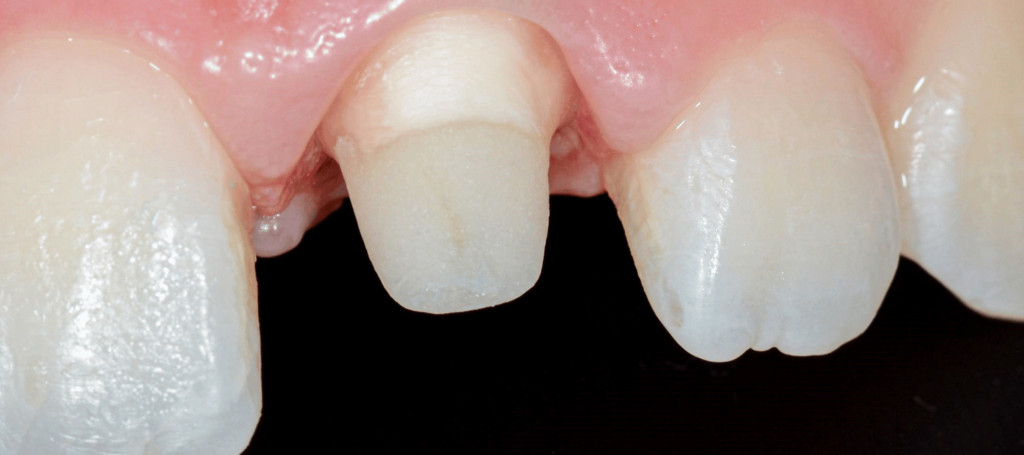 Restaurer la dent dépulpée délabrée