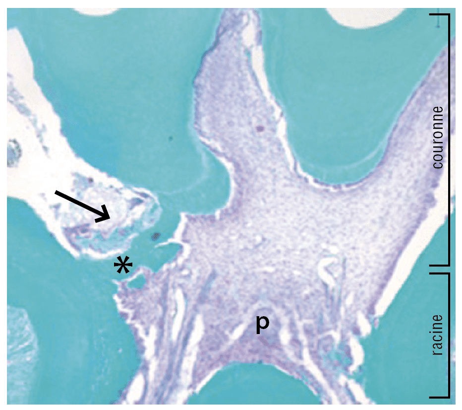 Fig. 2 – Coupe histologique réalisée sur une molaire de rat après coiffage pulpaire direct avec le biomatériau Biodentine et après une coloration au Trichrome de Masson. Elle met en évidence la présence d’un pont bien minéralisé (*) en regard de la zone d’effraction pulpaire coiffée par la Biodentine (flèche). p = pulpe. Document EA 2496.