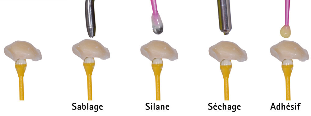 3. Étapes du conditionnement de la pièce prothétique lors du collage d’une restauration composite.