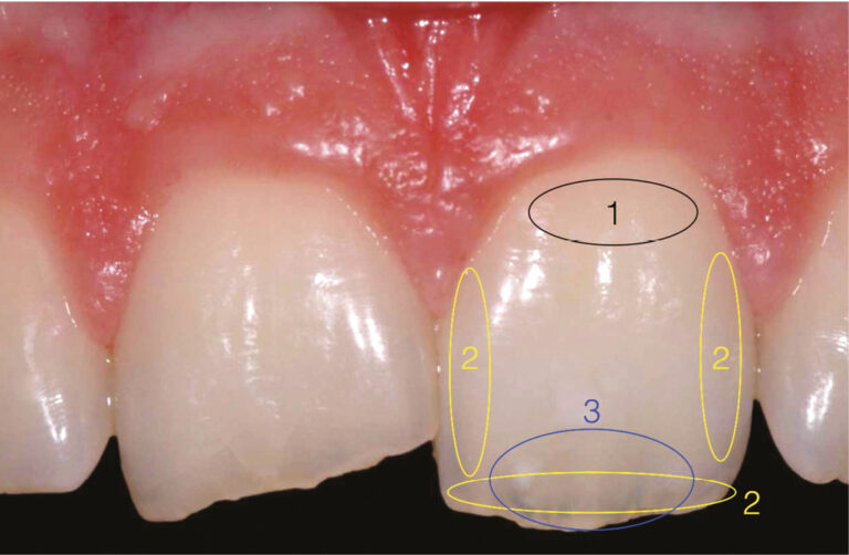 19. Les zones importantes lors du choix de la couleur. 1. La teinte et la saturation de la dentine doivent être enregistrées dans la zone cervicale de la dent. 2. Les caractéristiques de l’émail sont enregistrées au niveau des zones proximales ou du bord libre. 3. Les effets de masse, quand ils sont présents, doivent être enregistrés dans la zone moyenne de la dent.
