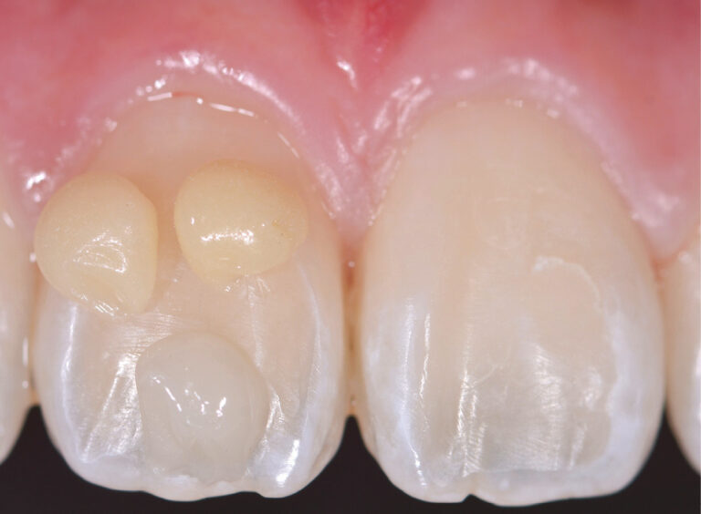 20. De petits échantillons de composite posés sur la dent facilitent le choix des masses de composite.