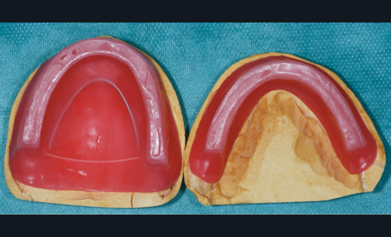 3. Maquettes d’occlusion maxillaire et mandibulaire de retour du laboratoire.
