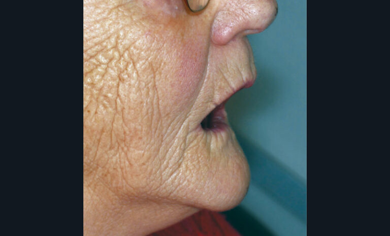 7. Soutien de la lèvre supérieure avec la maquette d’occlusion et vérification puis correction de l’angle naso-labial.