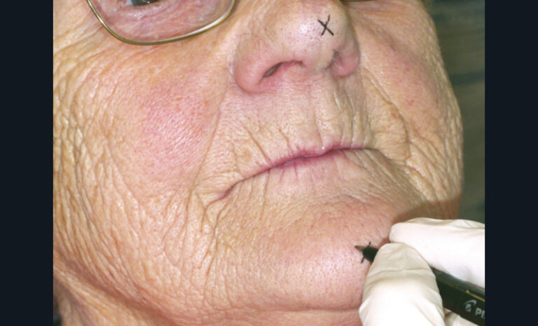 18. Traçage précis au crayon dermographique sur le menton et du nez de la patiente des repères permettant la mesure clinique de la DV.