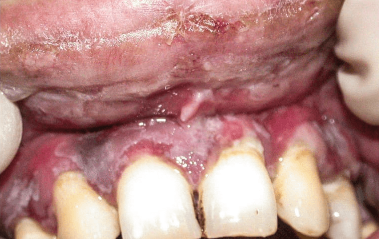 14. Gingivite érythémato-pultacée dans un érythème polymorphe.