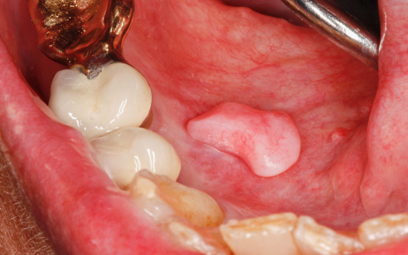 NODULE D’HYPERPLASIE FIBRO-EPITHELIALE (NHFE)