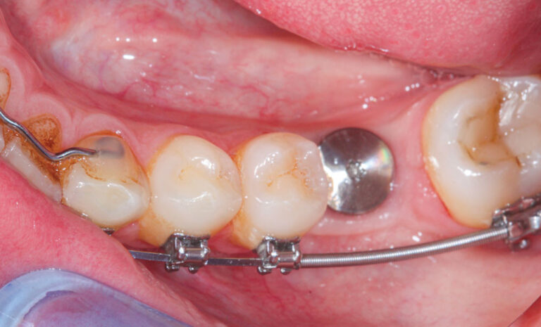 Non-remplacement dents extraites