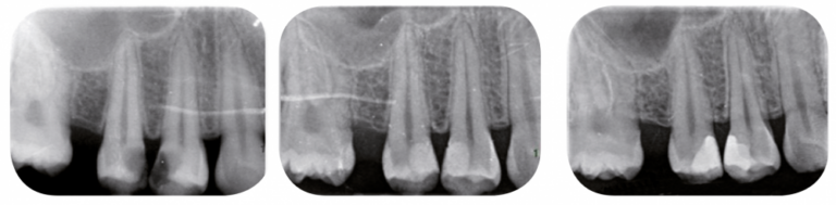 Fig. 5a-c - Coiffage pulpaire direct chez une patiente de 20 ans qui présente des lésions carieuses proximales sur ses deux prémolaires maxillaires droites avec une pulpite légère et réversible (a). Le coiffage pulpaire direct avec la Biodentine a également été choisi comme thérapeutique de préservation de la vitalité pulpaire. Le suivi est indispensable d’une part pour vérifier la suppression des signes cliniques initiaux, la non-apparition de nouveaux signes cliniques, la formation d’un pont minéralisé, et d’autre part pour intercepter les complications pulpaires (présence d’une lésion inflammatoire péri radiculaire d’origine endodontique). L’instauration d’un suivi à trois mois (b) puis à six mois (c) permet d’objectiver la disparition des signes cliniques et la non-apparition de lésion péri apicale.