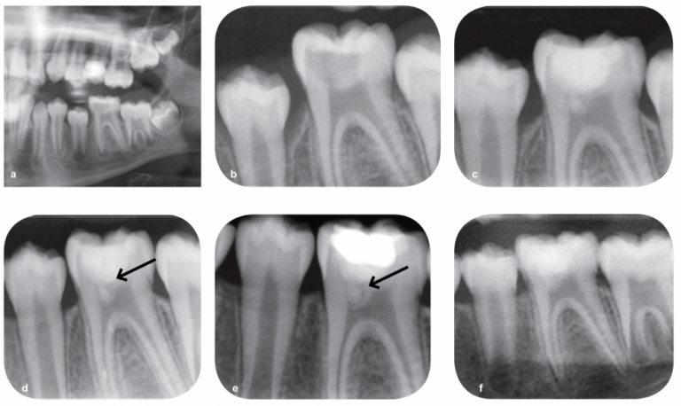 Fig. 6 - Pulpotomie partielle avec la Biodentine. Patiente de 11 ans présentant une pulpite réversible sur 36 (a-b). Après curetage de la dentine cariée, une effraction pulpaire a été observée et une pulpotomie partielle (c) a été mise en œuvre pour s’assurer de l’élimination de la pulpe inflammatoire. Le biomatériau de coiffage (Biodentine) a aussi été utilisé comme substitut dentinaire. Un composite a été réalisé lors du contrôle à deux mois. Un contrôle radiographique a été réalisé à deux mois (d) et à six mois (e). Dans ce cas particulier, le suivi radiographique de la zone péri apicale a été particulièrement difficile, du fait d’un réflexe nauséeux important empêchant la réalisation d’un bon cliché rétroalvéolaire. Un cliché panoramique de contrôle fut toutefois réalisé (f).