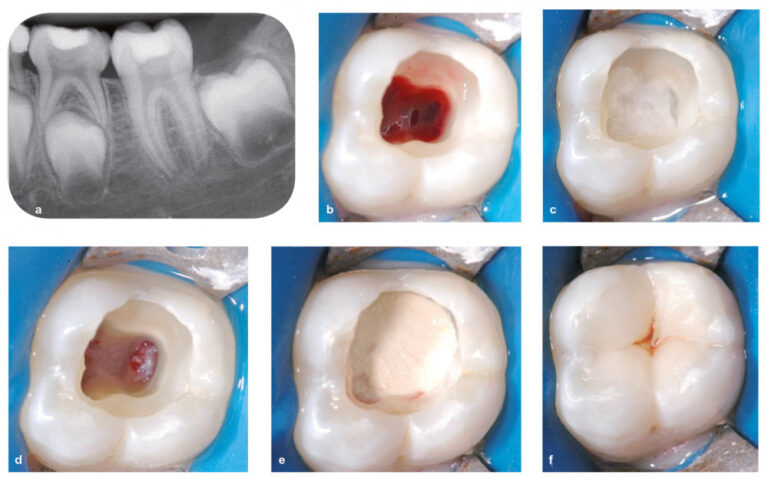 Fig. 7 - Pulpotomie camérale. Patiente de 9 ans présentant une pulpite sévère irréversible au niveau de la 36 (a). L’édification radiculaire est non terminée. Il a été décidé de mettre en œuvre une pulpotomie camérale. Après élimination de l’ancienne restauration et éviction de la dentine cariée, l’effraction pulpaire a été réalisée. Le plafond pulpaire a été éliminé ; la pulpe camérale est bien vitale et inflammatoire (b). La cavité est désinfectée et l’hémostase est recherchée à l’aide d’une boulette de coton imprégnée d’hypochlorite à 1 % (c). L’hémostase est objectivable au niveau de tous les orifices canalaires (d). Le matériau de coiffage est ensuite appliqué sur les orifices et dans la chambre pulpaire. Ici, le biomatériau Biodentine a été utilisé (e). Après la prise du biomatériau (12 minutes), dans la même séance, la restauration d’usage en résine composite a été réalisée (f). Une prescription d’antalgique (prise systématique, et non en cas de douleur, pendant 48 heures) a été faite à la fin de la séance.