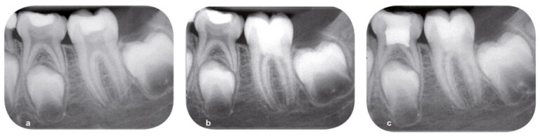 Fig. 8 - Un suivi clinique et radiographique est mis en place. La douleur a disparu dans les soixante-douze heures après la thérapeutique : radiographie préopératoire (a), radiographie postopératoire immédiate (b), radiographie après six mois (c). On objective la poursuite de l’édification radiculaire et la fermeture apicale. (Courtoisie du Dr François Bronnec)