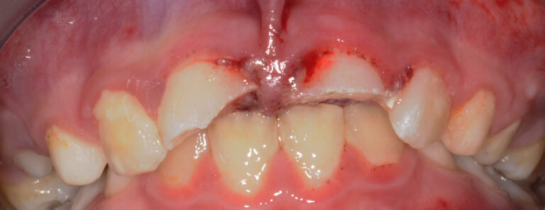 1. Situation initiale endo-buccale (vue vestibulaire) une heure après le traumatisme objectivant la fracture corono-radiculaire de 11 et 21.