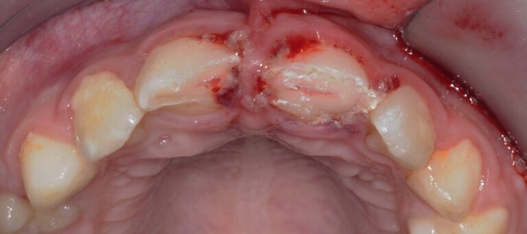 2. Situation initiale endobuccale (vue occlusale) une heure après le traumatisme objectivant la fracture corono-radiculaire de 11 et 21 avec effraction pulpaire.