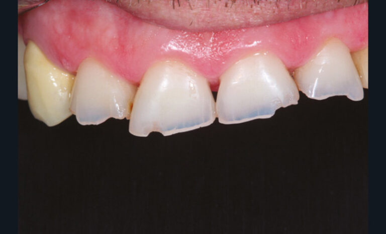 10, 11, 12, 13. Photographies de l’usure excessive des dents antérieures à la suite de la non-compensation de trois extractions mandibulaires non compensées (non-port de la prothèse amovible).