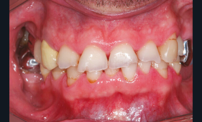 10, 11, 12, 13. Photographies de l’usure excessive des dents antérieures à la suite de la non-compensation de trois extractions mandibulaires non compensées (non-port de la prothèse amovible).