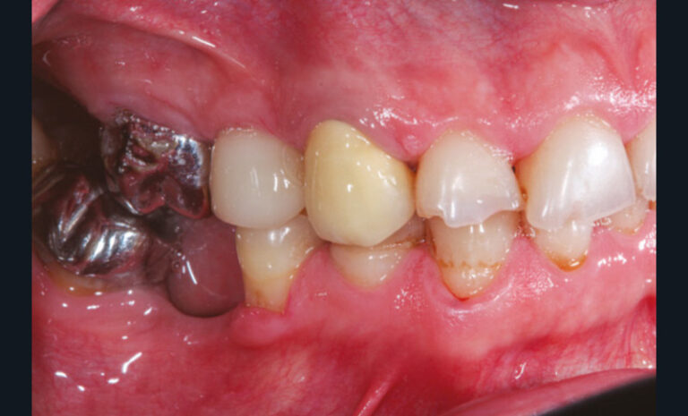 10, 11, 12, 13. Photographies de l’usure excessive des dents antérieures à la suite de la non-compensation de trois extractions mandibulaires non compensées (non-port de la prothèse amovible).