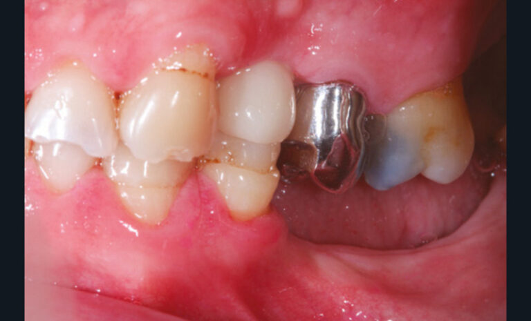 10, 11, 12, 13. Photographies de l’usure excessive des dents antérieures à la suite de la non-compensation de trois extractions mandibulaires non compensées (non-port de la prothèse amovible).