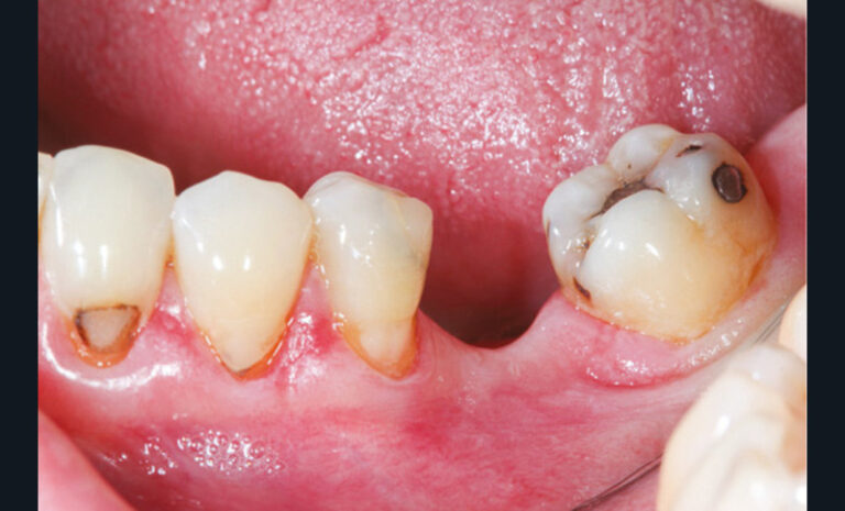 1 et 2. Photographie et radiographie de la version d’une deuxième molaire à la suite de la non-compensation de l’extraction de la première.