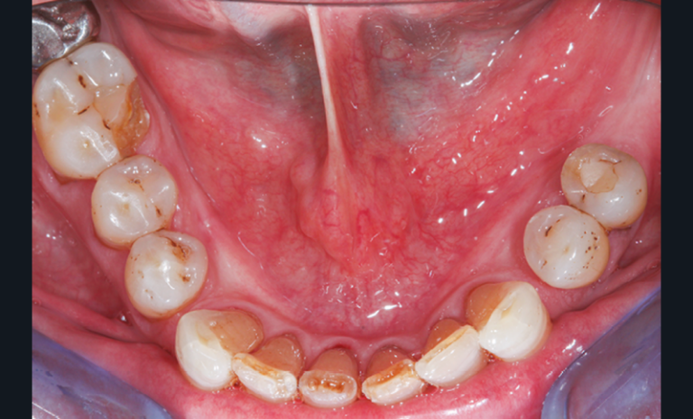 14 et 15. Fracture coronaire amélo-dentinaire d’une 46, en l’absence non compensée de 36 et 37 (le délabrement était faible : une cavité de classe I).