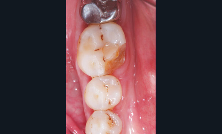 14 et 15. Fracture coronaire amélo-dentinaire d’une 46, en l’absence non compensée de 36 et 37 (le délabrement était faible : une cavité de classe I).