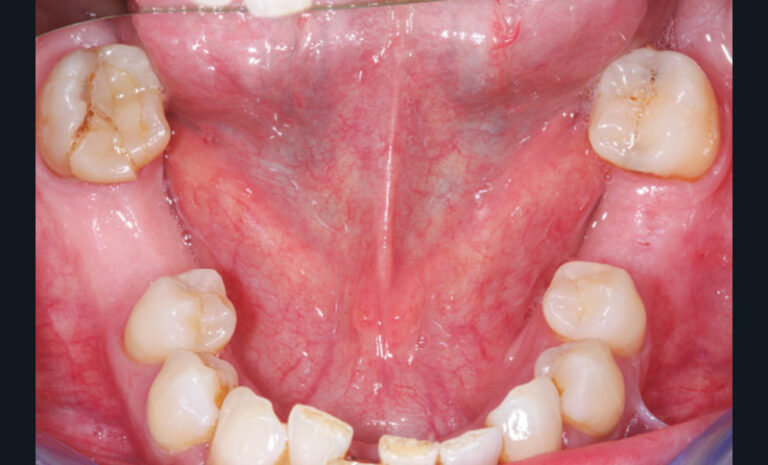 16 et 17. Fracture longitudinale d’une 37 en l’absence non compensée de 36 et 45 (le délabrement était important : dent dépulpée et cavité de classe II étendue).