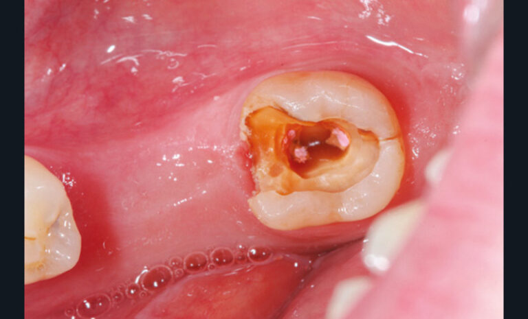 16 et 17. Fracture longitudinale d’une 37 en l’absence non compensée de 36 et 45 (le délabrement était important : dent dépulpée et cavité de classe II étendue).