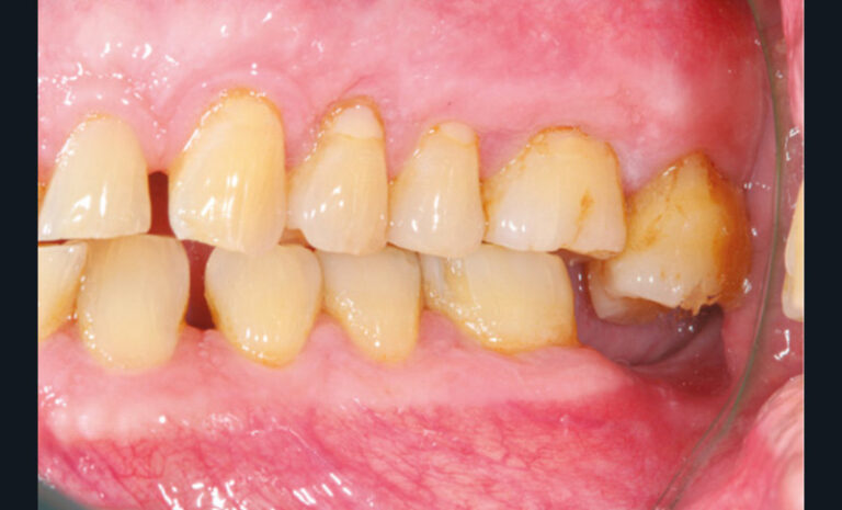 18 et 19. Photographies de deux molaires égressées à la suite de l’extraction non compensée des dents antagonistes.