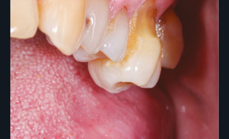18 et 19. Photographies de deux molaires égressées à la suite de l’extraction non compensée des dents antagonistes.