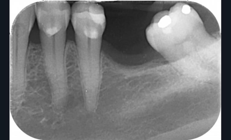 1 et 2. Photographie et radiographie de la version d’une deuxième molaire à la suite de la non-compensation de l’extraction de la première.
