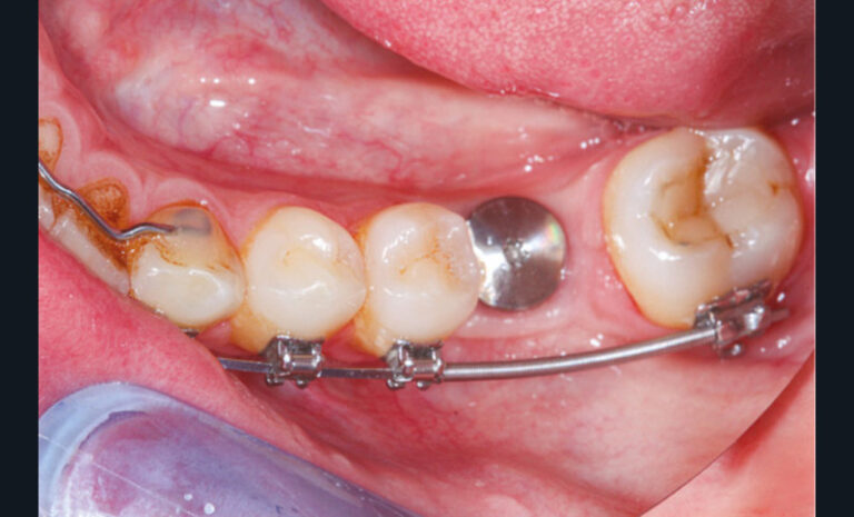 22 et 23. Photographie et radiographie d’un mainteneur d’espace de la 37 pendant l’ostéointégration de l’implant de 36. (Chirurgie : Dr Caroline Bolle)