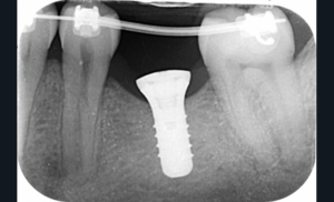 22 et 23. Photographie et radiographie d’un mainteneur d’espace de la 37 pendant l’ostéointégration de l’implant de 36. (Chirurgie : Dr Caroline Bolle)