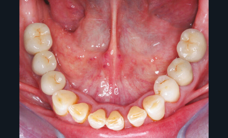 24 et 25. Photographie et radiographie d’une réhabilitation globale bimaxillaire selon le concept de l’arcade courte. (Chirurgies : Dr Patrick Limbour)