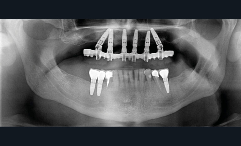 24 et 25. Photographie et radiographie d’une réhabilitation globale bimaxillaire selon le concept de l’arcade courte. (Chirurgies : Dr Patrick Limbour)