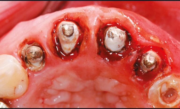 1b. La dépose prothétique laisse apparaître des limites prothétiques sous-gingivales avec violation de l’espace biologique, à l’origine de l’inflammation clinique.