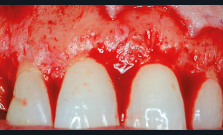 2b. La crête osseuse alvéolaire atteint anormalement la jonction émail-cément. L’attache supra-crestale est coronairement positionnée sur la dent, provoquant une couronne clinique courte.