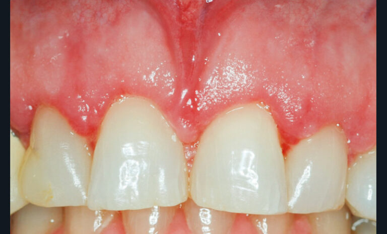 3c. Couronne clinique découverte dans son intégralité à la suite du repositionnement apical de l’attache supra-crestale.