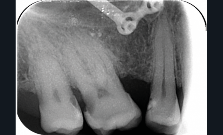 3 et 4. Photographie et radiographie de la version dentaire d’une deuxième et troisième molaires à la suite de la non-compensation de l’extraction de la première ; des caries proximales sont détectables uniquement à la radiographie.