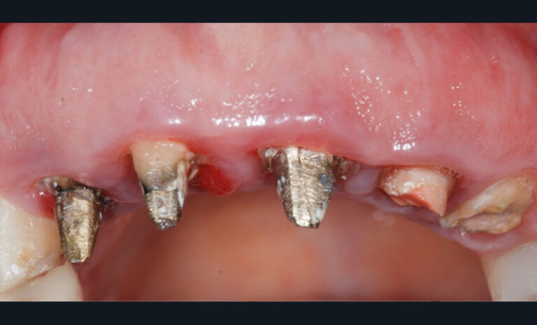 4a. Limites prothétiques sous-gingivales et quasi-absence de rétention prothétique.