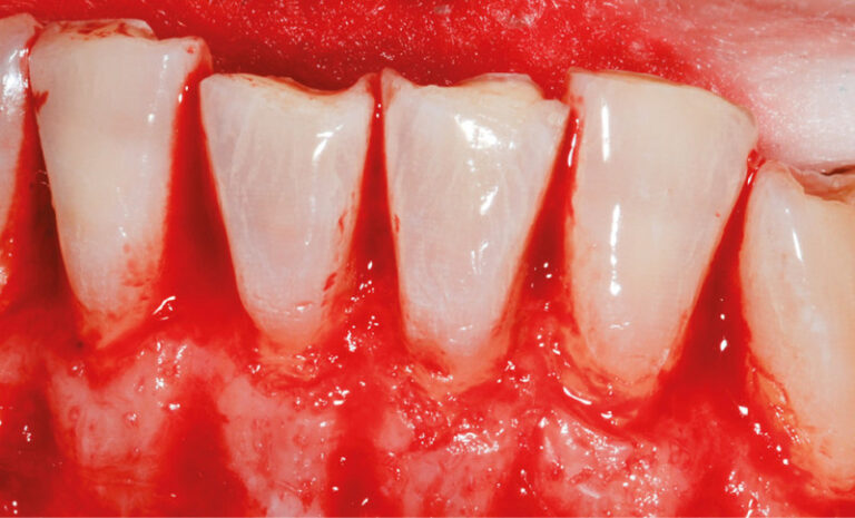 3b. Gingivectomie associée à une ostectomie limitée de 1 à 2 mm en vestibulaire pour recréer l’espace de l’attache supra-crestale.