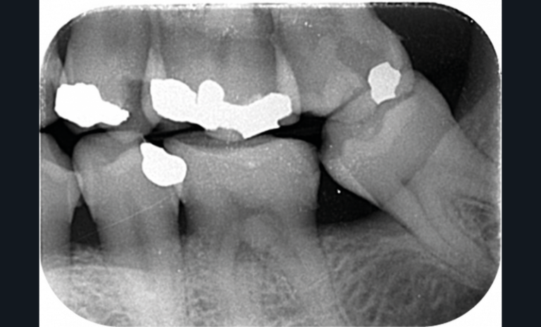 5 et 6. Radiographie bite-wing de contrôle d’un patient après l’extraction non compensée d’une deuxième molaire et radiographie 3 ans plus tard objectivant une carie profonde (vu en urgence pour une pulpite de la première molaire).